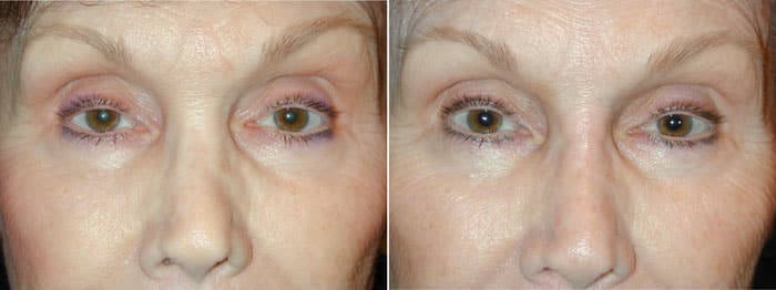 Before and After 5 Minute Injectable Nose Job