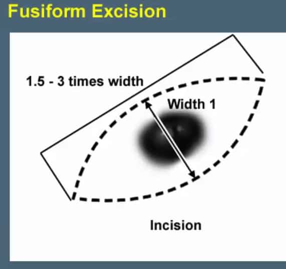 Surigcal excision