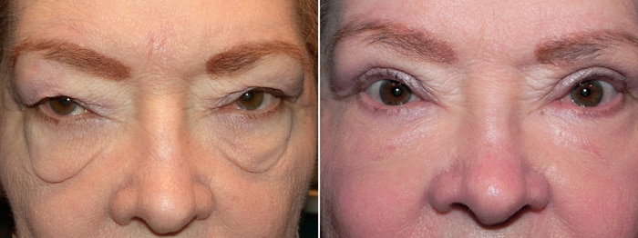 Eyelid Surgery with Laser Festoon Treatment