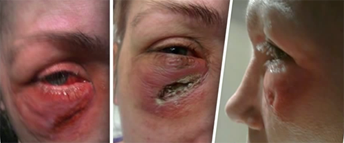 under eye fillers gone wrong