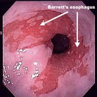 Barrett's esophagus