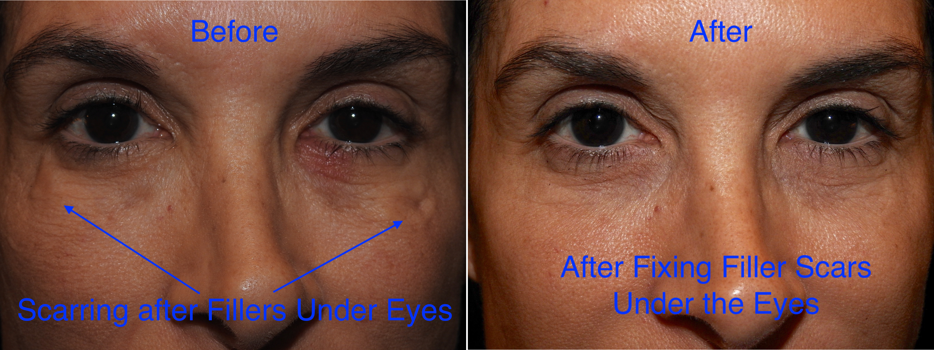 problems with fillers under the eyes 