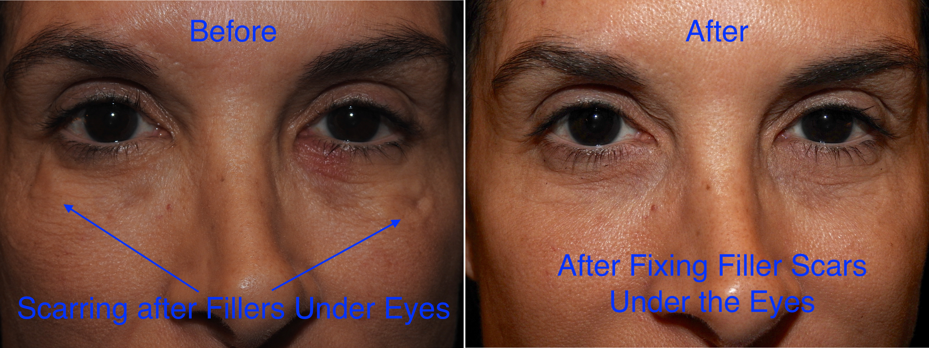 problems with fillers under the eyes