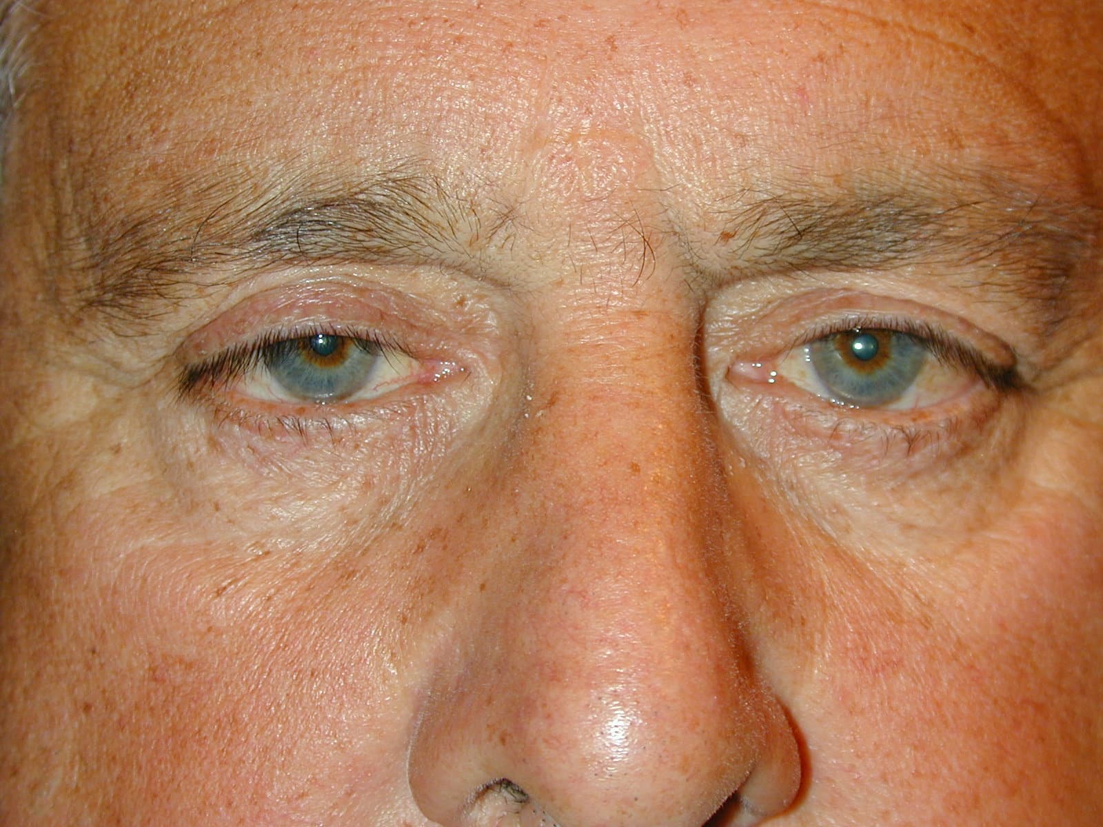 Heaviness in upper lid
