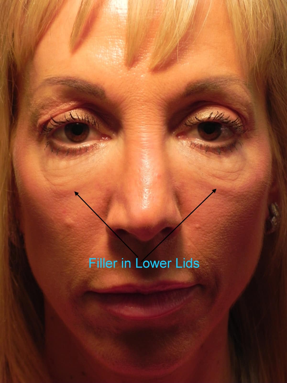 Eyelid Surgery Richmond VA | Blepharoplasty Surgery | Eyelid Tuck