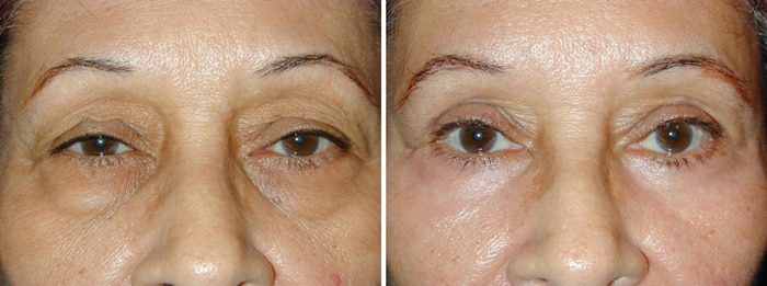 Before and After Lower Laser Eyelid Surgery with Lower Eyelid Laser Skin Resurfacing