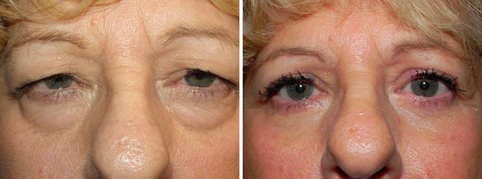 Before and After Upper and Lower Laser Eyelid Surgery