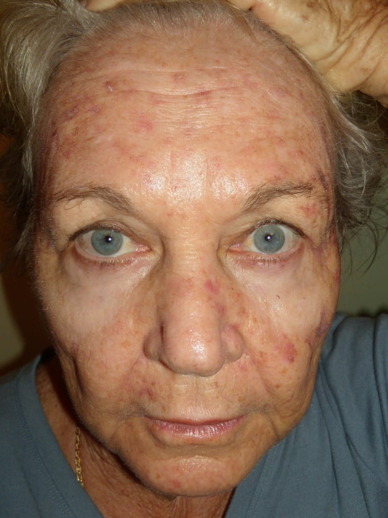 lesions on face