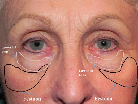 Before and after photos of the same patient, showing under-eye bags removed but Festoons (malar mounds) still present, highlighting the difference between the two