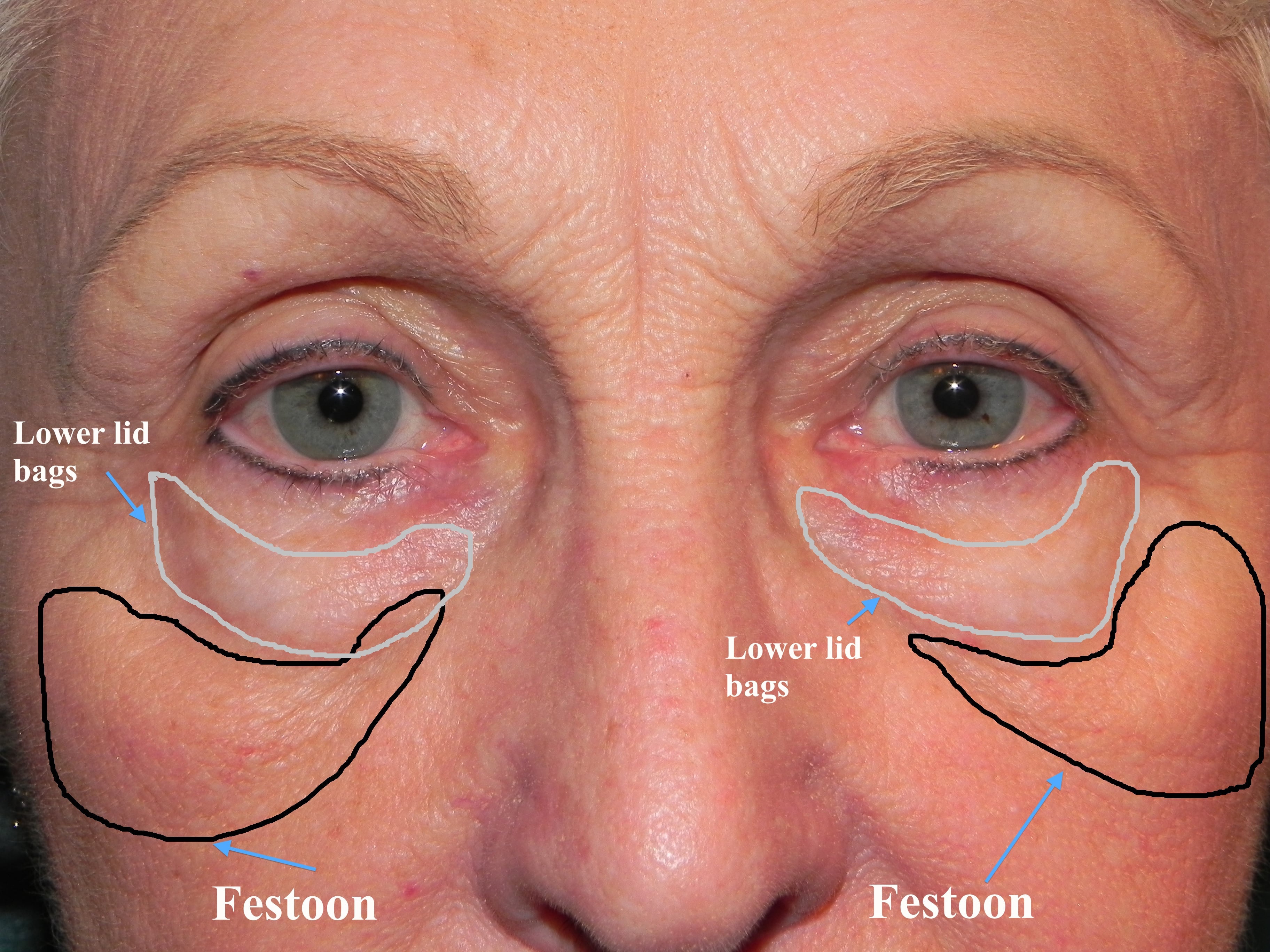 Before lower lid  surgery
