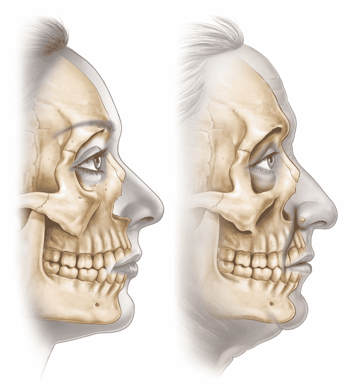 Deeper bony changes