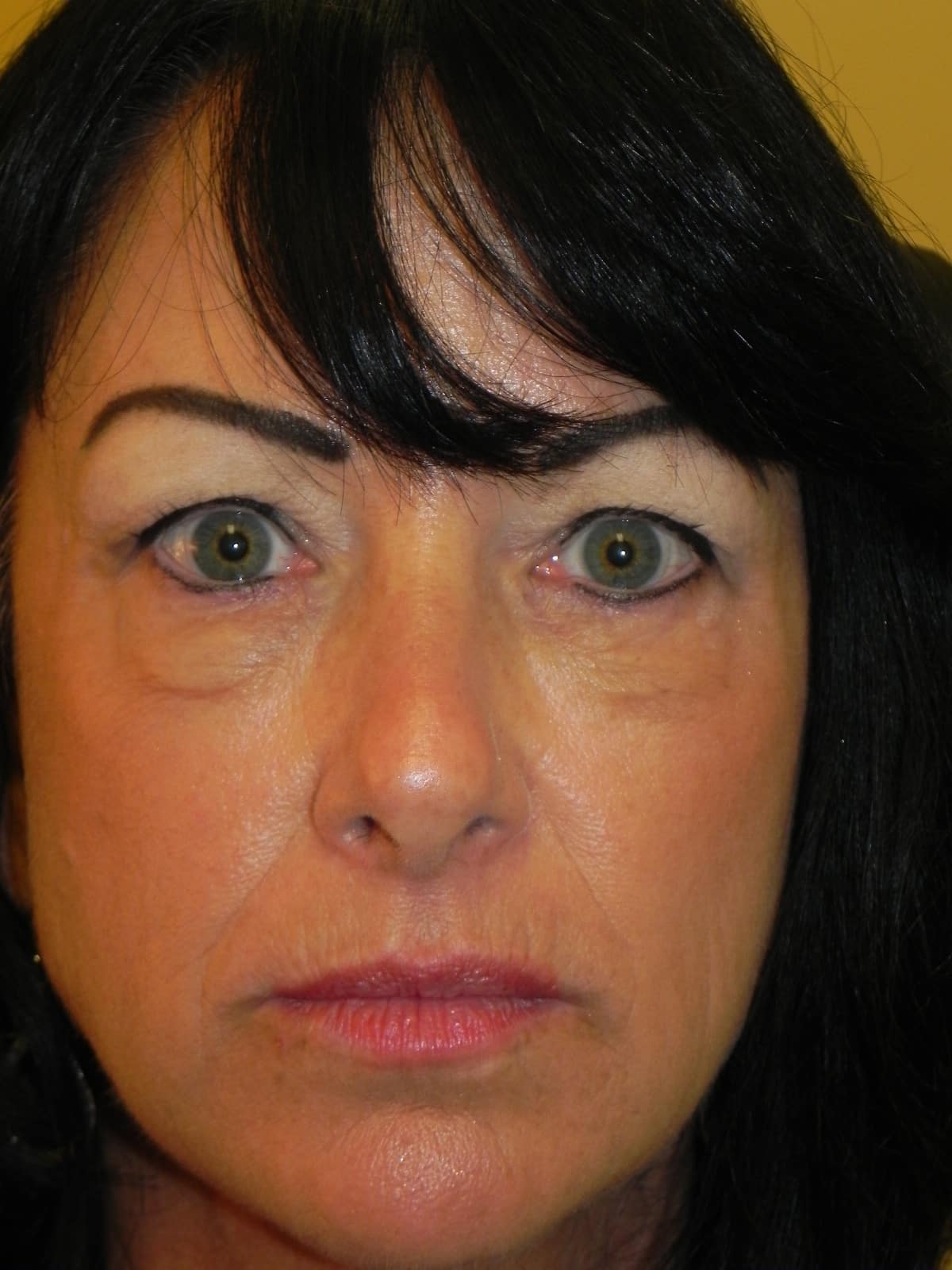  After treatment photo dissolving under eye fillers by Dr. Scheiner 