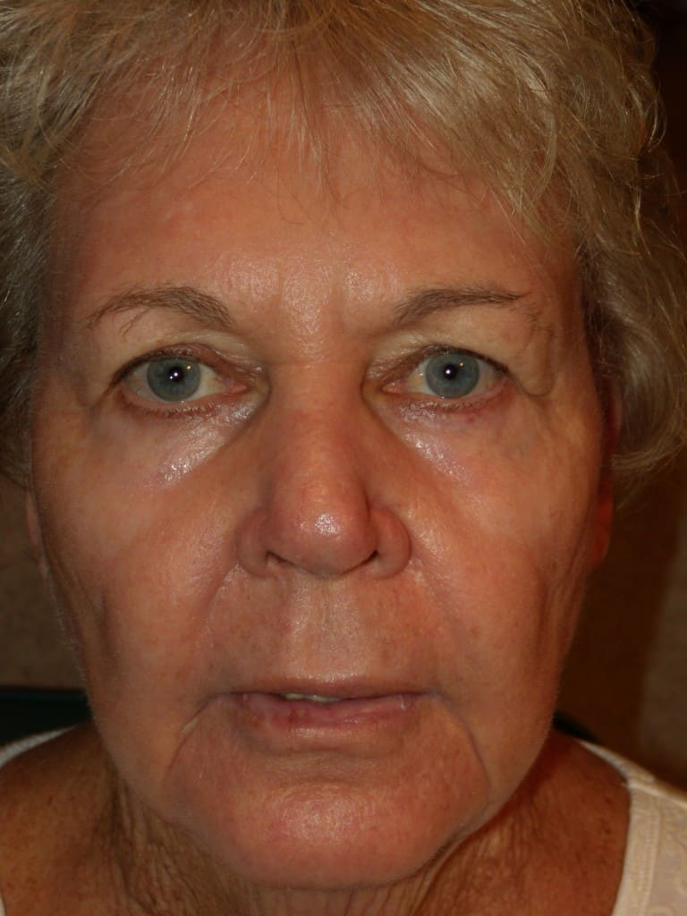 results after surgery