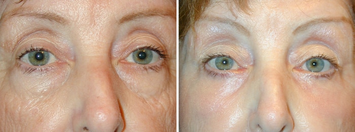Before and After Lower Laser Eyelid Surgery with Lower Eyelid Laser Skin Resurfacing