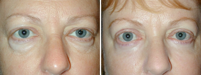 Before and After Lower Laser Eyelid Surgery with Lower Eyelid Laser Skin Resurfacing 2