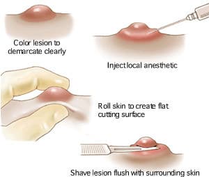 shave biopsy