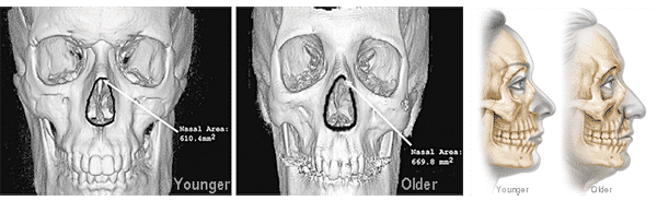 In these photos we can see the loss of volume around the nose.