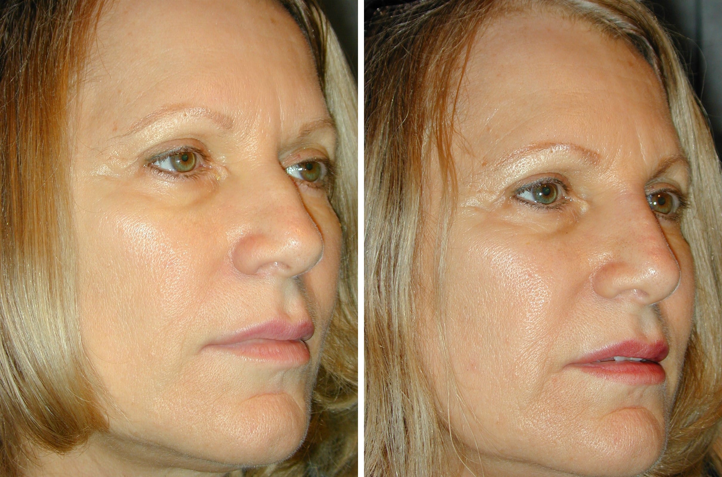 Before and After 5 Minute Nose Job