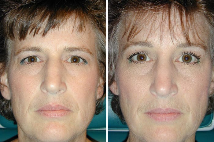 Before and After Minimal Incision Browlift