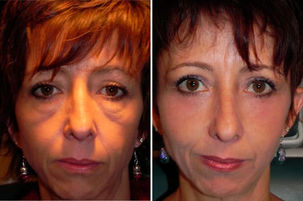 Dr. Scheiner's revolutionary Festoon Treatment