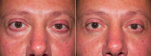 Fillers to treat under eye bags