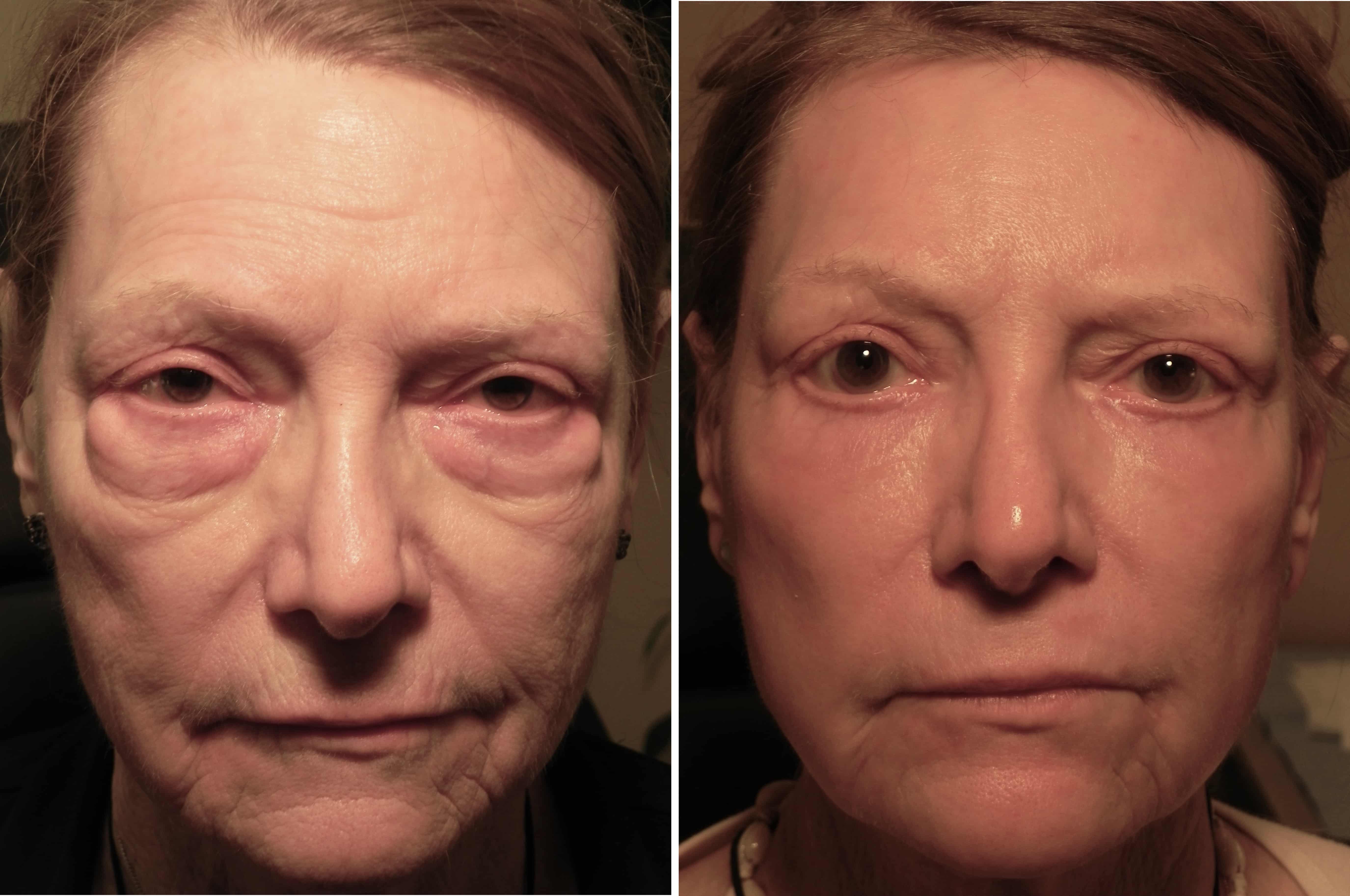 Under Eye Bags Removal