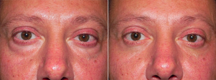 Laser Eyelid Surgery Patient 