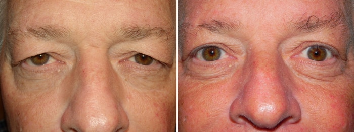 Before and After Upper Laser Eyelid Surgery 2