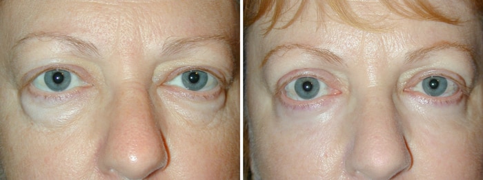 Before and After Lower Laser Eyelid Surgery with Lower Eyelid Laser Skin Resurfacing