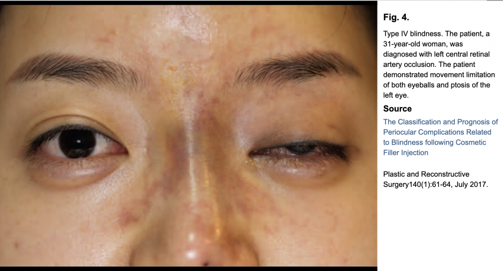 under eye fillers causing blindness