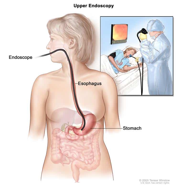 New Treatment for Barret's Esophagus