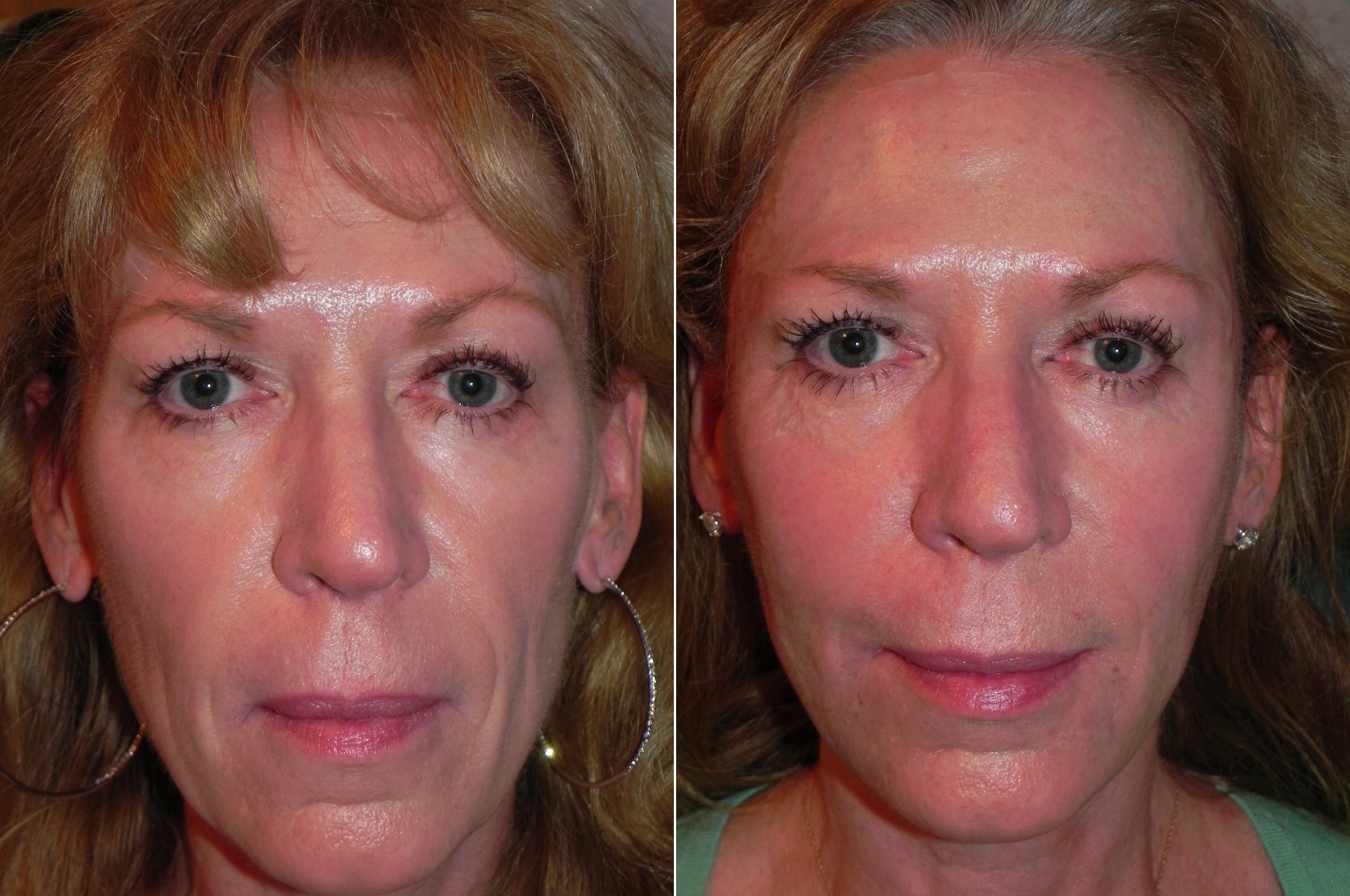 Sculptra Before and After