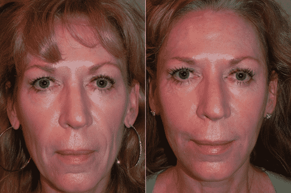 Treatments that restore lost volume in the face can reverse these aging effects.