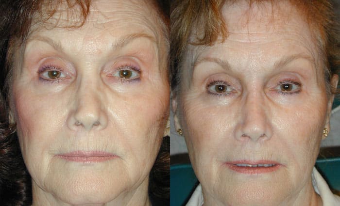 Before and After 5 Minute Injectable Nose Job