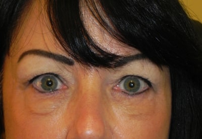Using facial fillers under the eyes can result in an irregular appearance if done by an inexperienced practitioner.