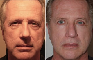 Michael Before and After Total Face Resurfacing