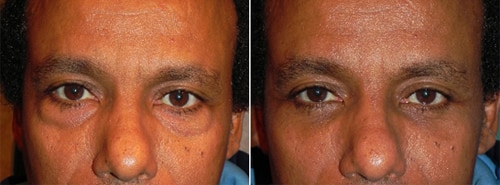 Before and After Treatment