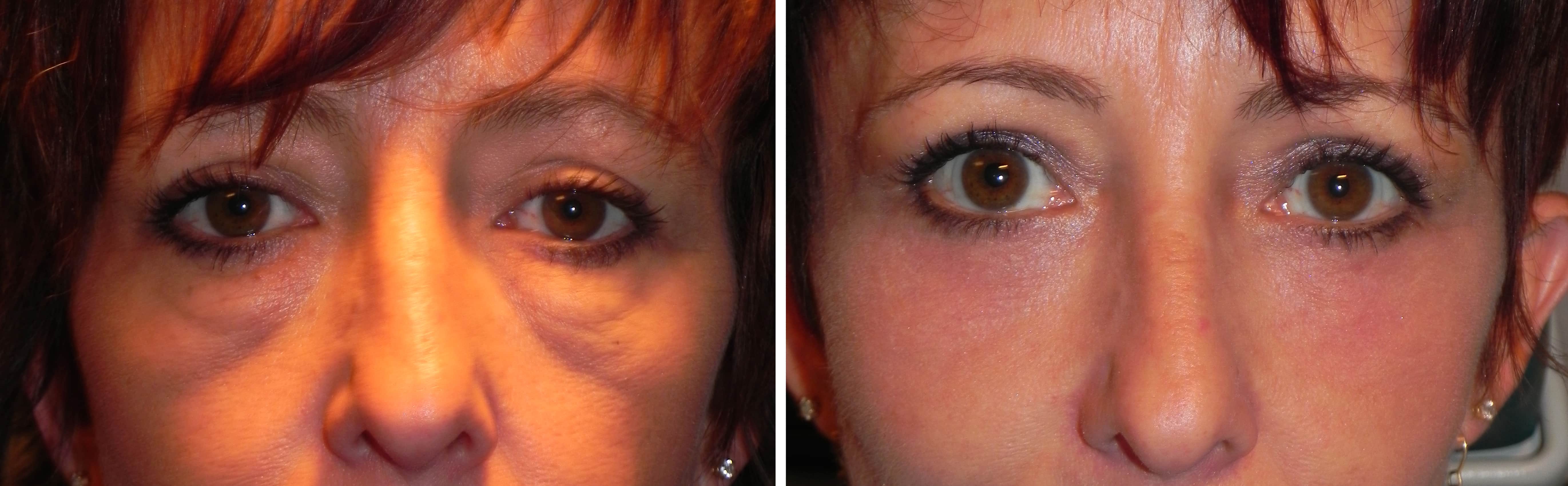 Before and after Treating lower lid fullness and Festoons