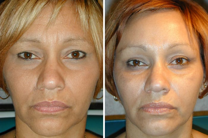 Before and After Minimal Incision Browlift