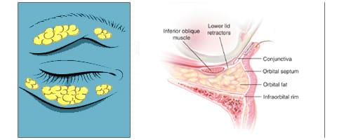 Relaxation of ligaments and sheets in the lower eyelid region can cause fat around our eyes to shift.