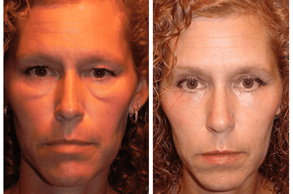 Lower eyelid bags or Festoons can also make a person look tired or sick, even when they are feeling fine.