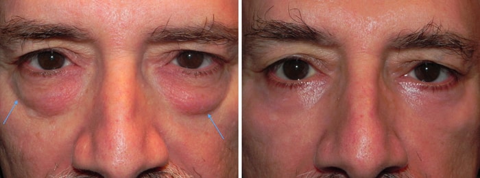 Non-Surgical Treatment for Thin Eyelid Skin, Hollowing, and Dark Under Eye  Circles 