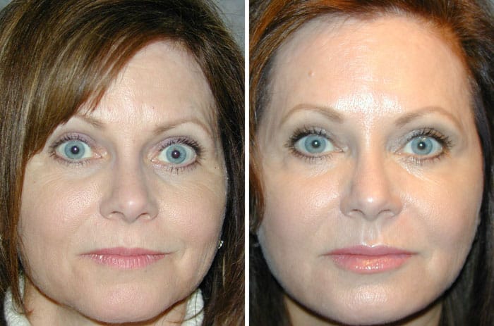 Before and After VolumaLift™