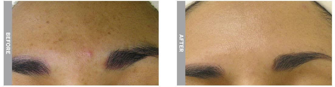 HydraFacial treatment for brown spots (before and after 4 sessions)
