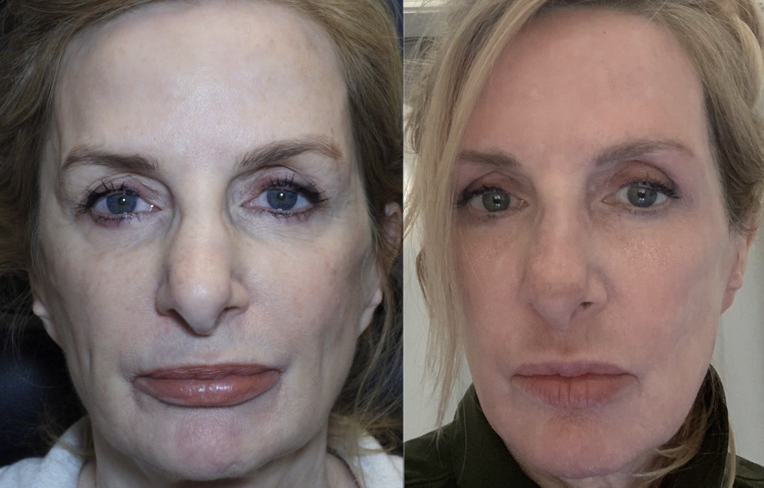 before and after blepharoplasty 