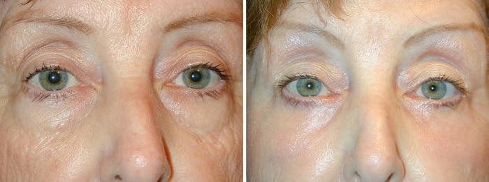 Lower Laser Eyelid Surgery with Lower Eyelid Laser Skin Resurgacing