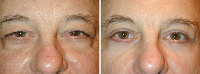 Before and After Lower Laser Eyelid Surgery with Lower Eyelid Laser Skin Resurfacing