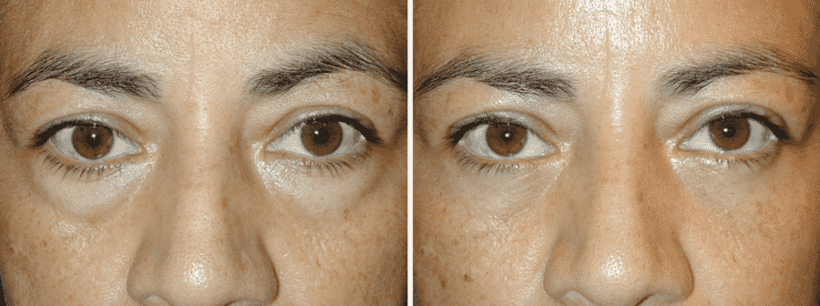 man after laser blepharoplasty