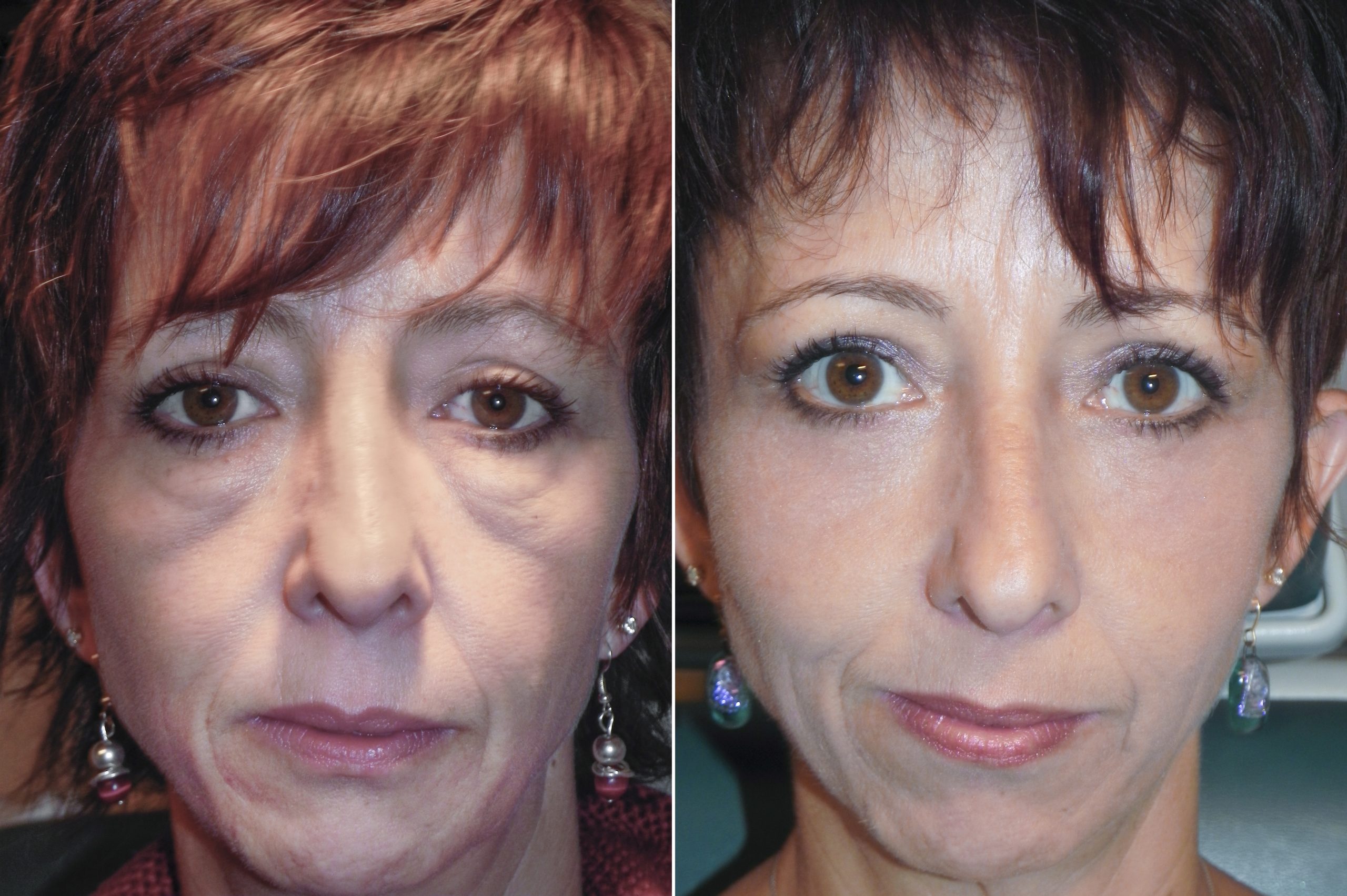 Before and after of woman with eye festoons