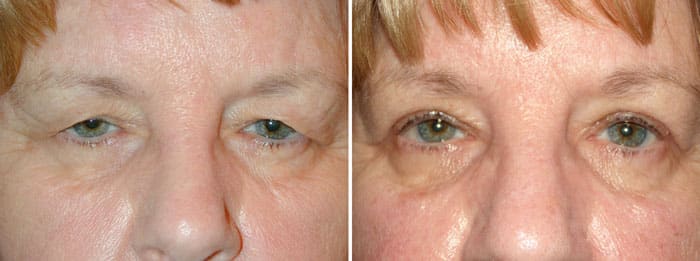 Laser Eyelid Surgery Patient 2